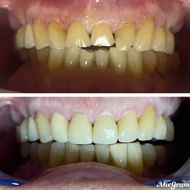 Before After Photo 11