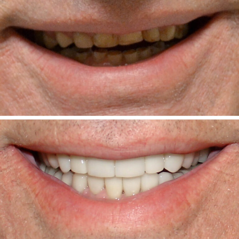 Before After Photo 2