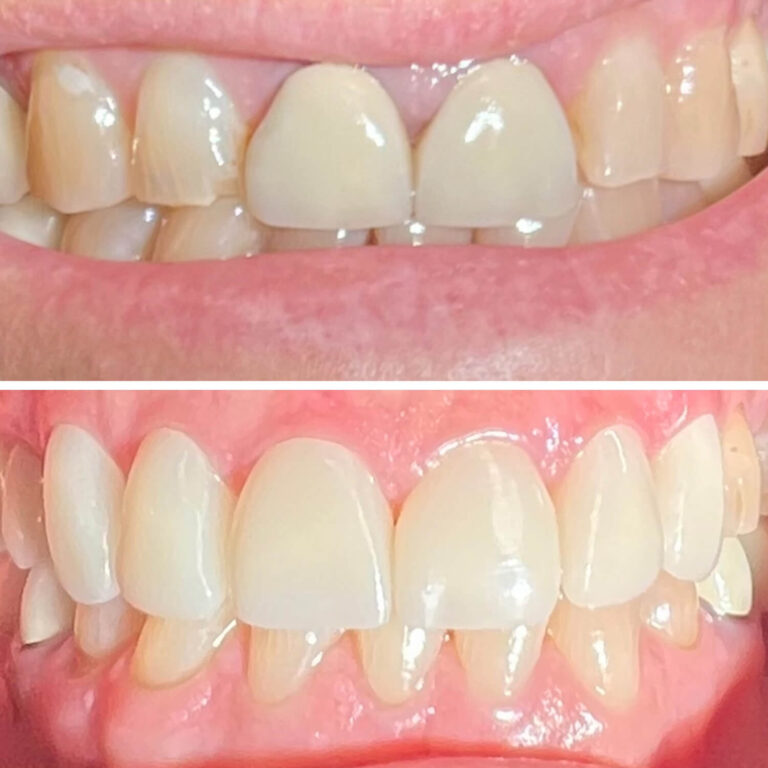 Crowns Before After Photo